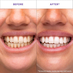 Teeth Whitening Strips